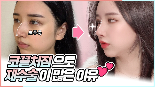 코끝 처짐으로 인한 코 재수술이 많은 이유는?
