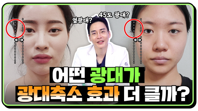 광대축소술 효과를 보는 케이스는 따로있다?